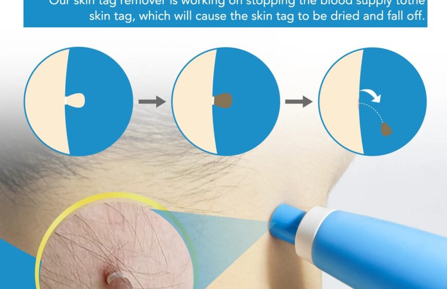 2 in 1 Auto Skin Tag Remover Kit Painless Mole Wart Skin Tag Removal Device for Face Body 4